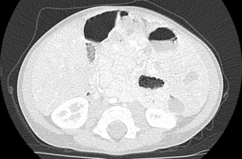 File:Asplenia syndrome (Radiopaedia 73083-83792 Axial lung window 103).jpg
