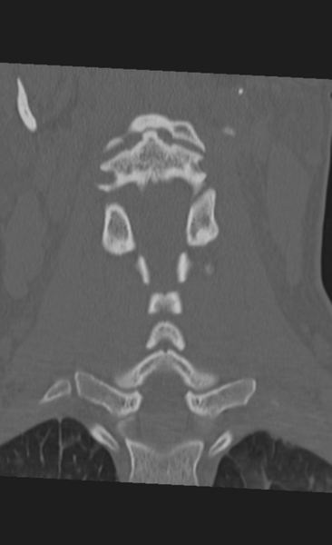 File:Atlanto-occipital dissociation (Radiopaedia 33848-35013 Coronal bone window 24).png