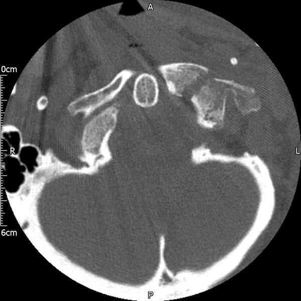 File:Atlas fracture with Currarino type A congenital defect (Radiopaedia 71747-82144 Axial bone window 28).jpg