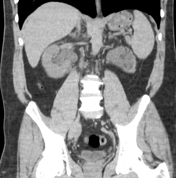 File:Atrophic kidney due to severe chronic obstructive hydronephrosis (Radiopaedia 40828-43474 Coronal non-contrast 5).jpg