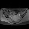 Atypical deep infiltrating endometriosis (Radiopaedia 44470-48125 Axial T1 fat sat 11).jpg