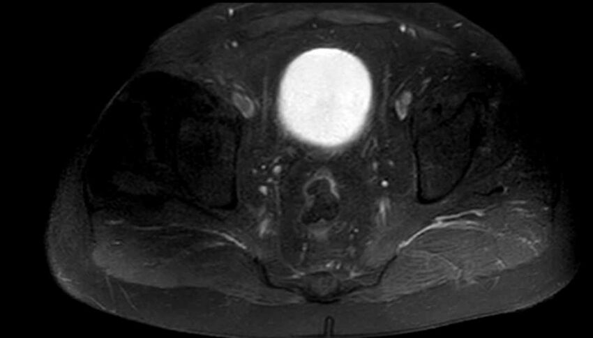Atypical lipomatous tumor - thigh (Radiopaedia 68975-78734 Axial T1 C+ fat sat 99).jpg