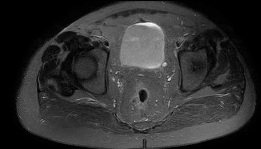 Atypical lipomatous tumor - thigh (Radiopaedia 68975-78734 Axial T2 fat sat 97).jpg