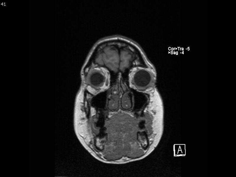 File:Atypical meningioma - intraosseous (Radiopaedia 64915-74572 Coronal T1 41).jpg