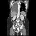 Atypical retroperitoneal lymphocoeles with large leiomyoma of uterus (Radiopaedia 32084-33024 B 17).jpg