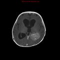 Atypical teratoid rhabdoid tumor (Radiopaedia 10712-11183 Axial T1 C+ 9).jpg