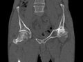 Avascular necrosis of the left hip (Radiopaedia 75068-86125 Coronal bone window 13).jpg