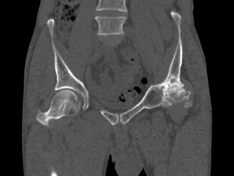 File:Avascular necrosis of the left hip (Radiopaedia 75068-86125 Coronal bone window 13).jpg