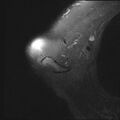 Avulsion fracture - greater tuberosity of humerus (Radiopaedia 71216-81515 Axial PD fat sat 20).jpg