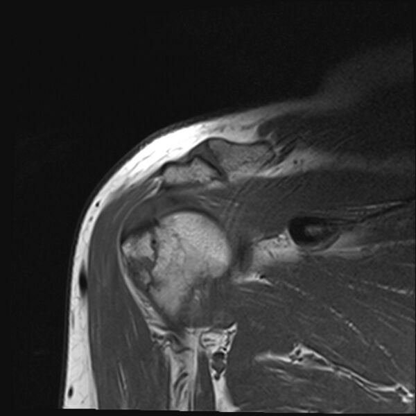 File:Avulsion fracture - greater tuberosity of humerus (Radiopaedia 71216-81515 Coronal T1 8).jpg