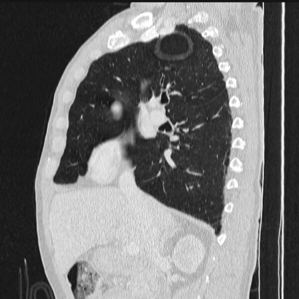 File:Azygos lobe (Radiopaedia 38259-40275 lung window 41).jpg