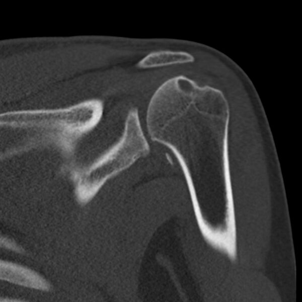 File:Bankart lesion (Radiopaedia 22771-22798 Coronal bone window 26).jpg