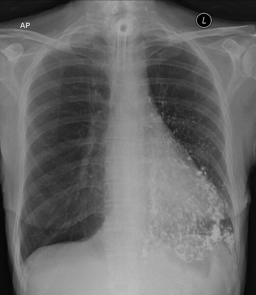 File:Barium bronchogram from aspiration (Radiopaedia 87052).jpg