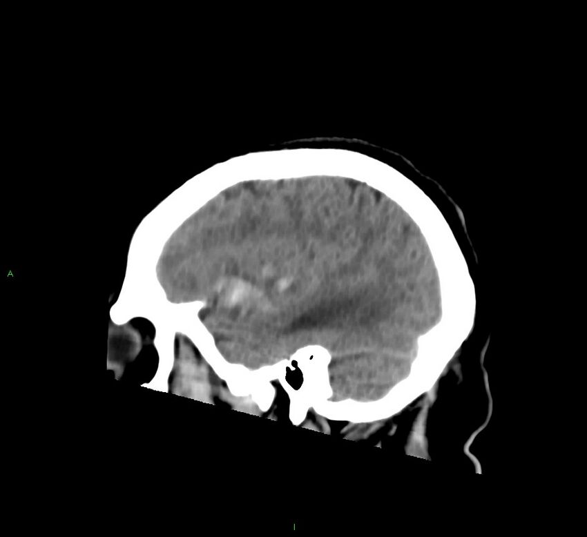 Basal ganglia hemorrhage (Radiopaedia 58763-65985 C 17).jpg