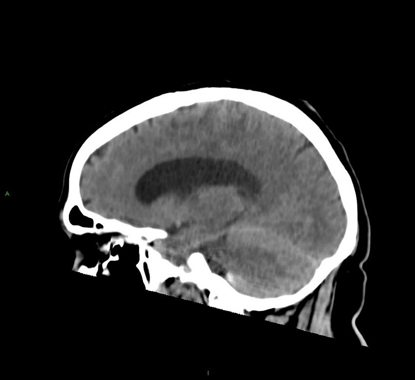 Basal ganglia hemorrhage (Radiopaedia 58763-65985 C 38).jpg