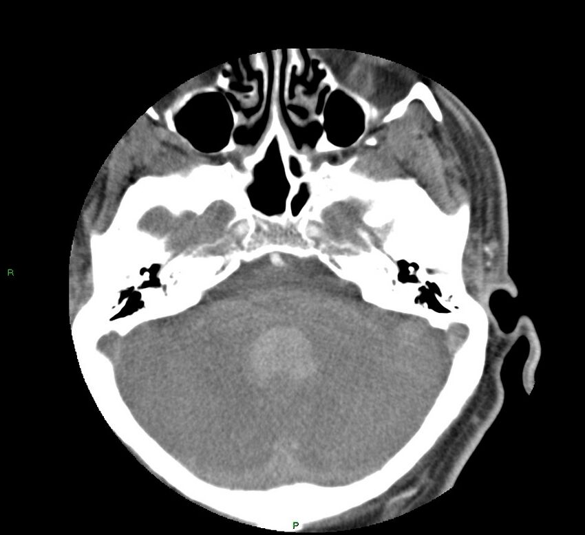 Basal ganglia hemorrhage (Radiopaedia 58763-65985 D 47).jpg