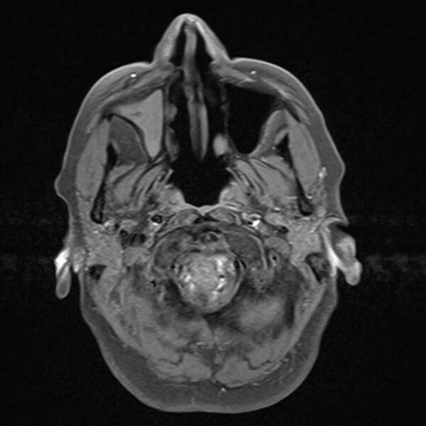 File:Base of skull chondrosarcoma (Radiopaedia 30410-31070 Axial T1 fat sat 1).jpg