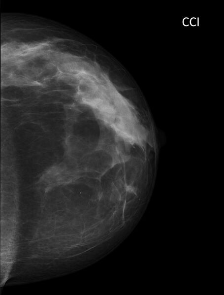 File:Benign breast clustered microcalcifications (Radiopaedia 84548-99945 B 1).jpg