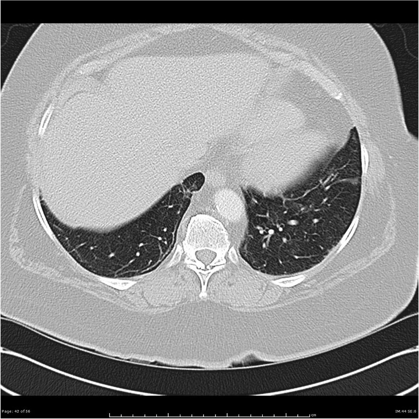 Benign metastasizing leiomyoma (Radiopaedia 26803-26962 Axial lung window 42).jpg