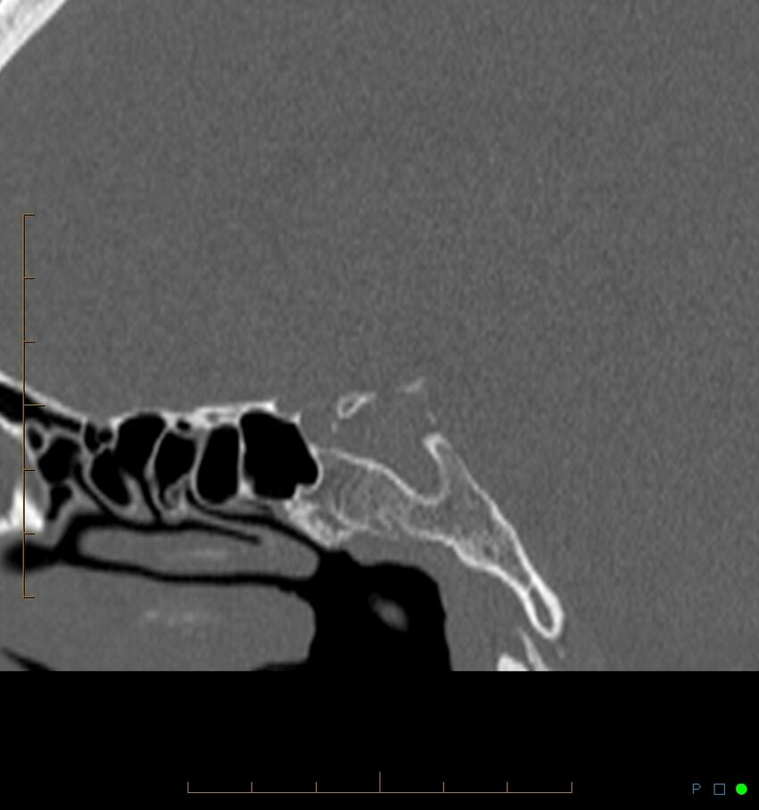 Benign notochordal cell tumor (probable) (Radiopaedia 65475-74546 Sagittal bone window 33).jpg