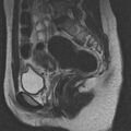 Bicornuate uterus (Radiopaedia 24677-24949 B 8).jpg