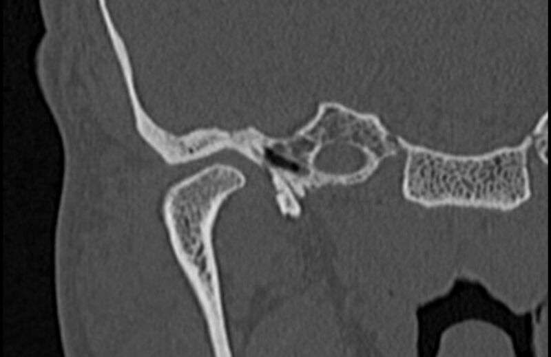 File:Bilateral cholesteatoma (Radiopaedia 54898-61172 Coronal bone window 11).jpg