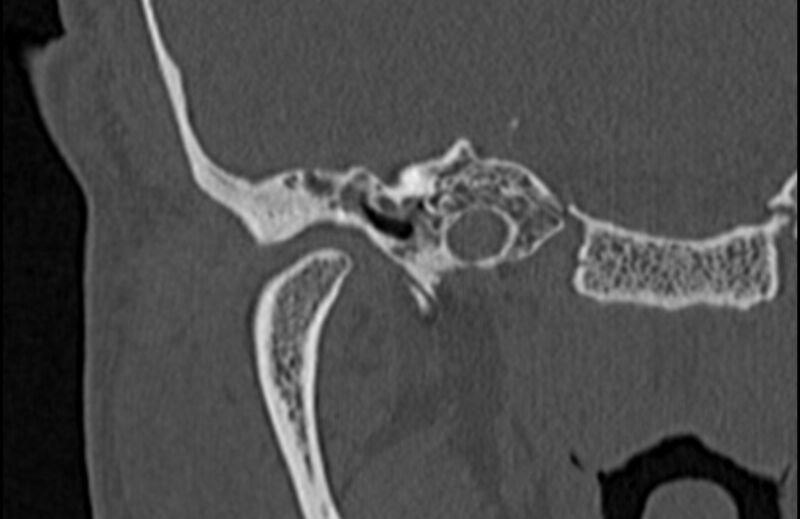 File:Bilateral cholesteatoma (Radiopaedia 54898-61172 Coronal bone window 17).jpg