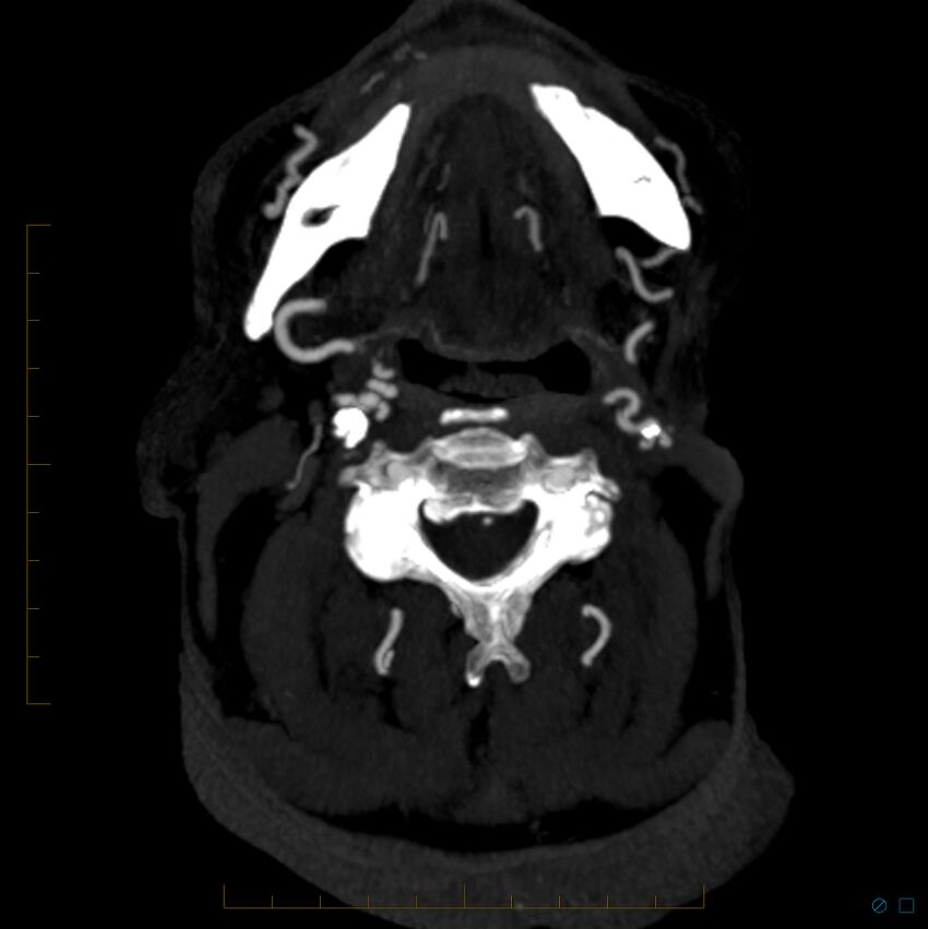 Bilateral chronic common carotid occlusion (Radiopaedia 50849-56362 D 37).jpg