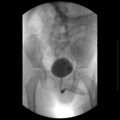 Bilateral duplex kidneys with left-sided uterocoele (Radiopaedia 20811-20726 A 3).jpg