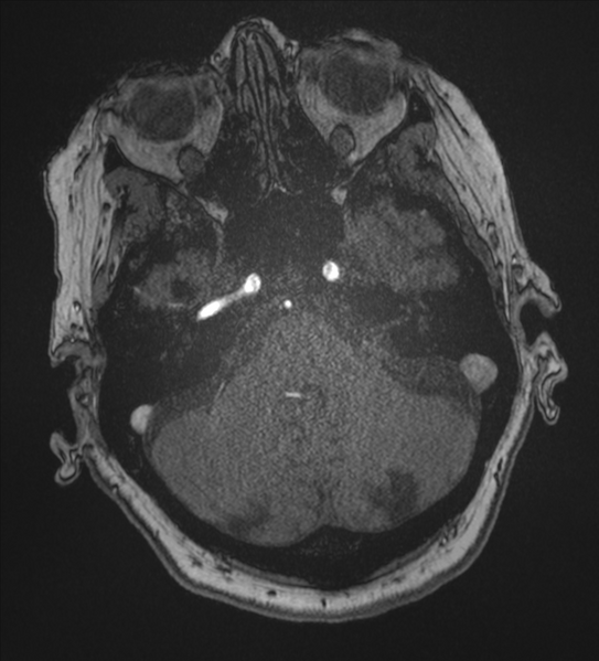 File:Bilateral fetal posterior communicating arteries (Radiopaedia 41286-44102 Axial MRA 39).png