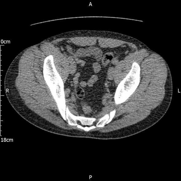 File:Bilateral medullary nephrocalcinosis with ureteric calculi (Radiopaedia 71269-81569 Axial non-contrast 111).jpg