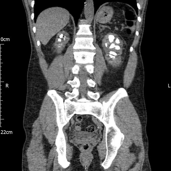 File:Bilateral medullary nephrocalcinosis with ureteric calculi (Radiopaedia 71269-81569 Coronal non-contrast 49).jpg
