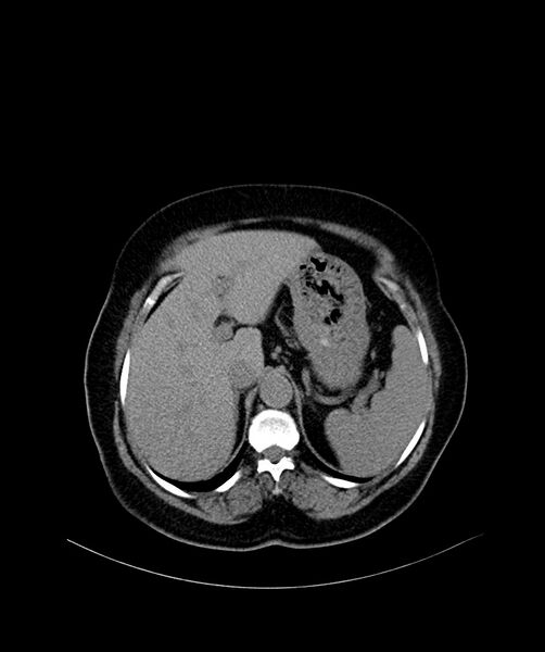 File:Bilateral sporadic synchronous clear cell renal cell carcinoma (Radiopaedia 85035-100572 Axial non-contrast 13).jpg