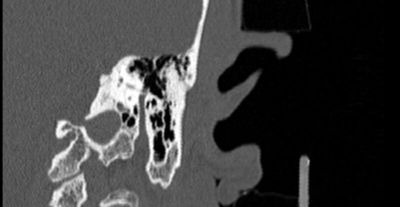 File:Bilateral temporal bone fractures (Radiopaedia 29482-29970 B 57).jpg