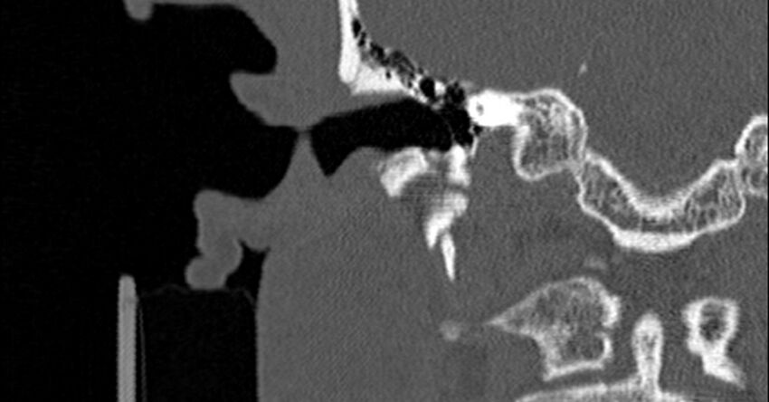 Bilateral temporal bone fractures (Radiopaedia 29482-29970 Coronal non-contrast 90).jpg