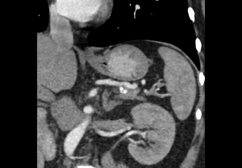 File:Bilateral urolithiasis with incidentally detected splenic artery aneurysm and left inferior vena cava (Radiopaedia 44467-48127 Ob. Cor. C+ Art. 18).jpg