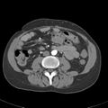 Biliary necrosis - liver transplant (Radiopaedia 21876-21845 A 36).jpg