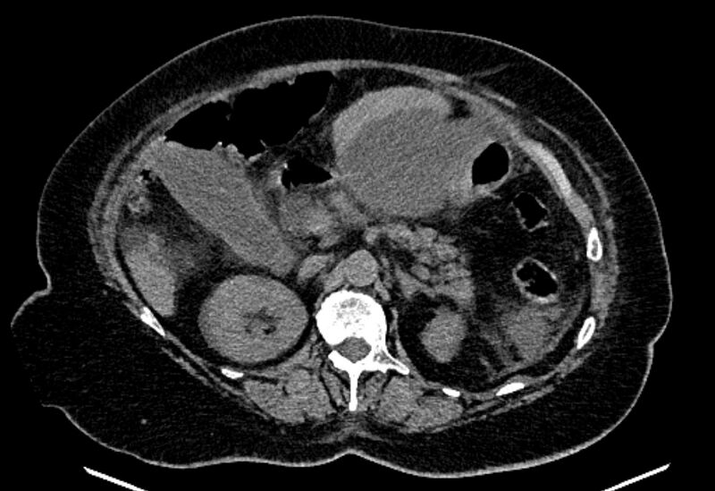 File:Biliary pancreatitis (Radiopaedia 72289-82823 Axial non-contrast 98).jpg