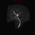 Biliary tree anatomical variant - biliary trifurcation (Radiopaedia 12531-12750 Coronal 3D MRCP 10).jpg