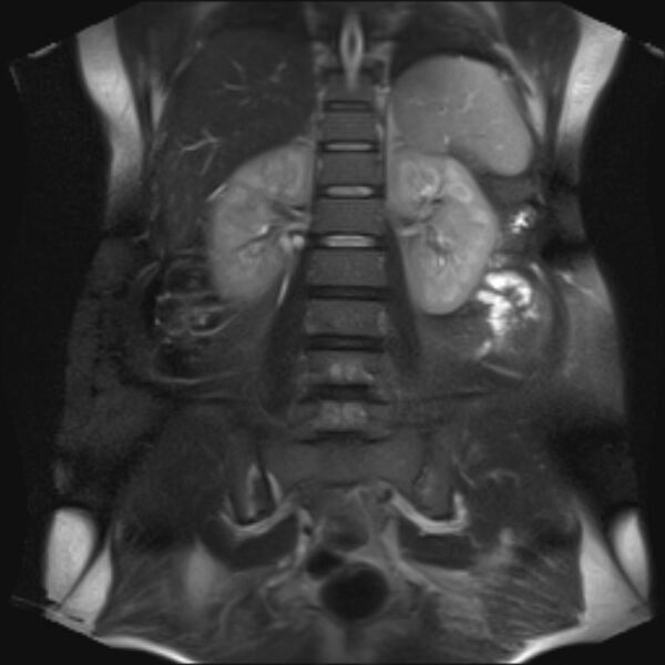 File:Bilobed placenta accreta (Radiopaedia 69648-79591 Coronal T2 fat sat 28).jpg