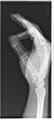 Boxer fracture (Radiopaedia 11249-11613 C 1).jpg