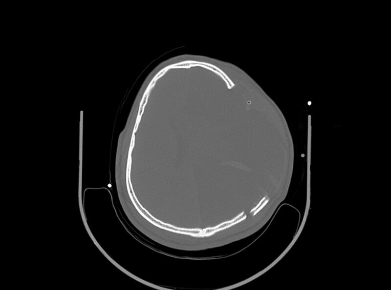 File:Brain injury by firearm projectile (Radiopaedia 82068-96087 A 126).jpg