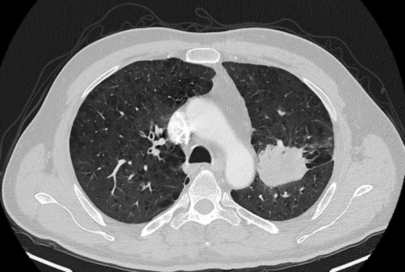 File:Brain metastases - lung cancer primary (Radiopaedia 75060-86116 Axial lung window 18).jpg