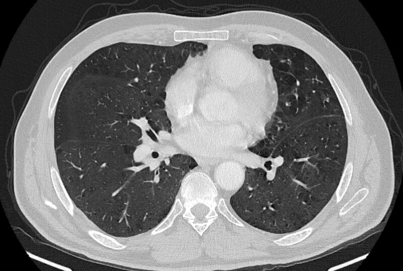 File:Brain metastases - lung cancer primary (Radiopaedia 75060-86116 Axial lung window 33).jpg