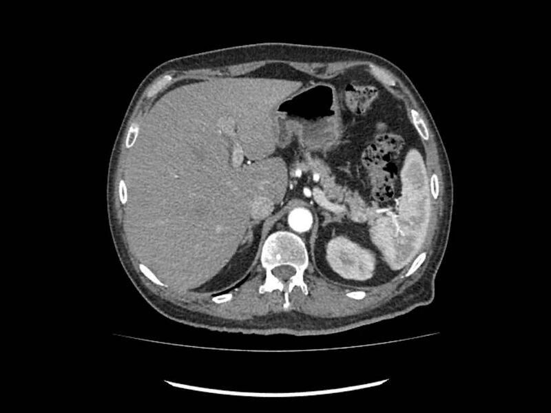 File:Brain metastases from renal cell carcinoma (Radiopaedia 42222-45328 A 10).jpg
