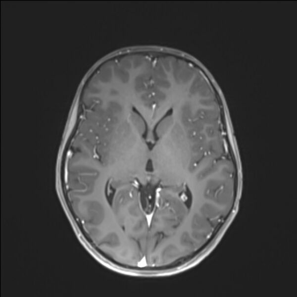 File:Brainstem glioma (Radiopaedia 70548-80674 Axial T1 C+ 82).jpg