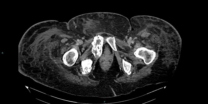 File:Breast cancer pelvic bony metastases (Radiopaedia 84470-99824 Axial bone window 68).jpg