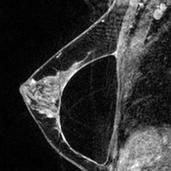 File:Breast implants - MRI (Radiopaedia 26864-27035 Sagittal T2 101).jpg