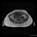 Broad ligament fibroid (Radiopaedia 49135-54241 Axial T1 6).jpg