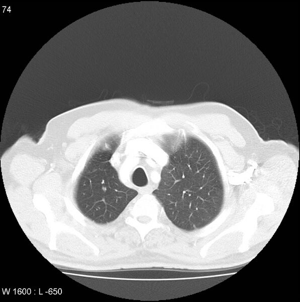 File:Bronchial carcinoid tumor with right lower lobe collapse (Radiopaedia 29060-29422 B 12).jpg